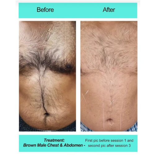 BeforeAfter Men Full Front
